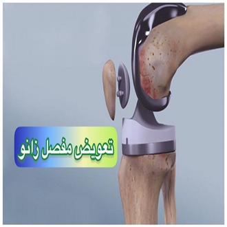 تعویض مفصل زانو در زنجان