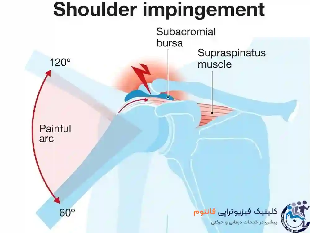 گیرافتادگی شانه