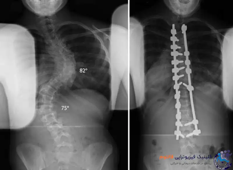 تصویر ct scan در اسکلیوز