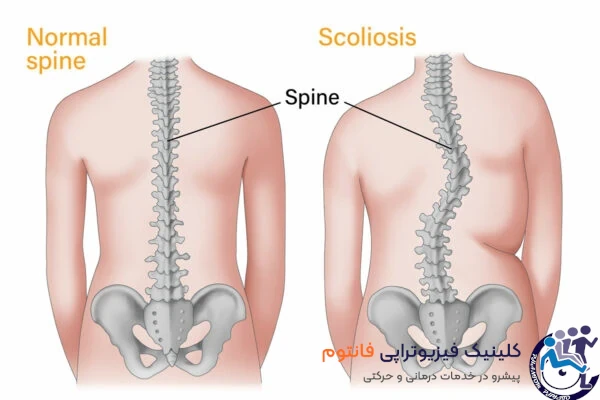 اسكليوز