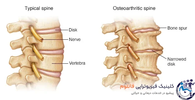 تنگی کانال نخاعی