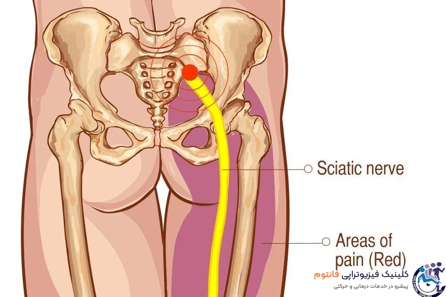 عصب سیاتیک