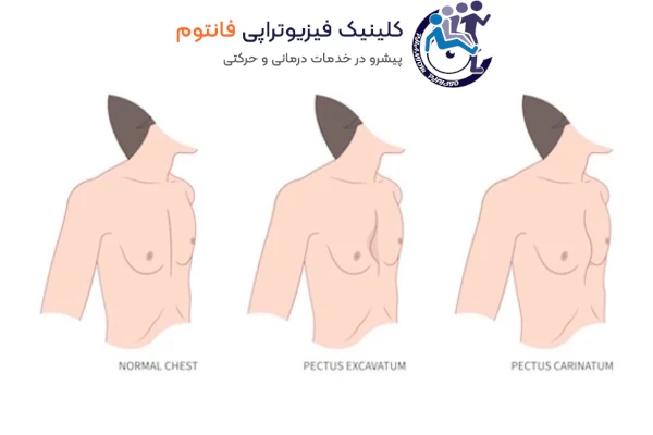 انواع سینه کبوتری