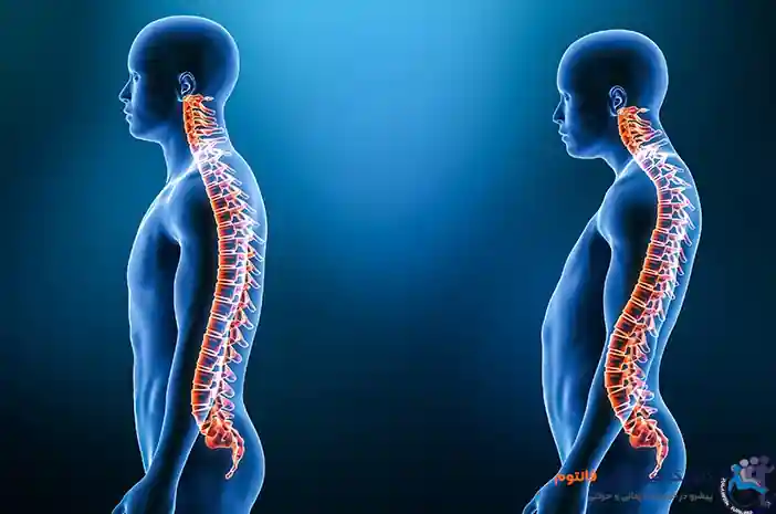 لوردوز(Lordosis)