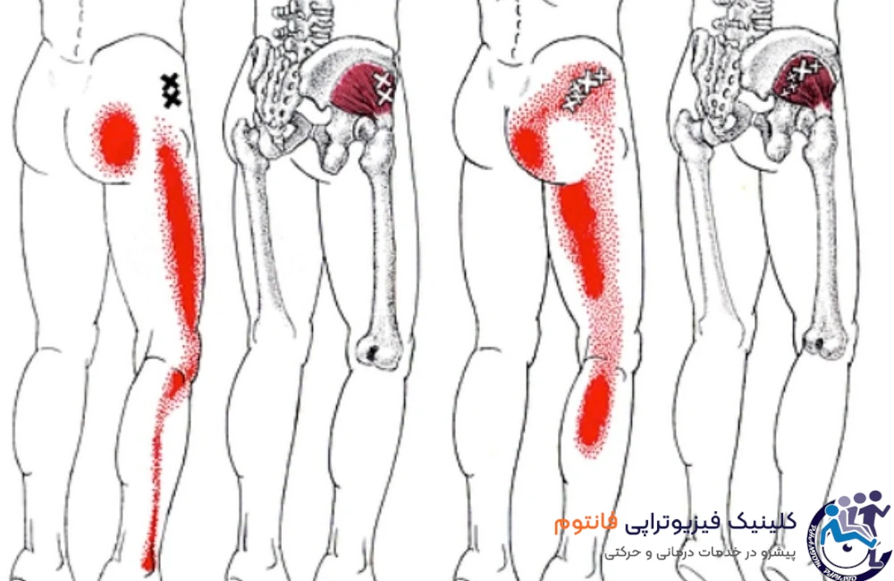 الگوی درد در سندروم پیریفورمیس