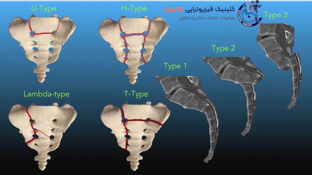 انواع شکستگی ساکروم