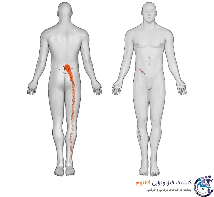 درد مفصل ساکروایلیاک