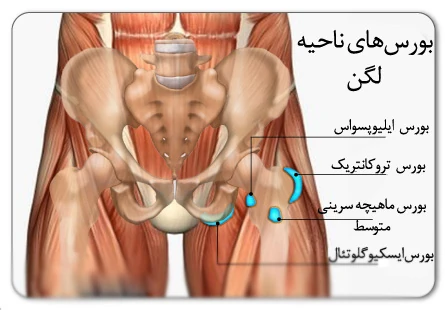 بورسیت ناحیه لگن