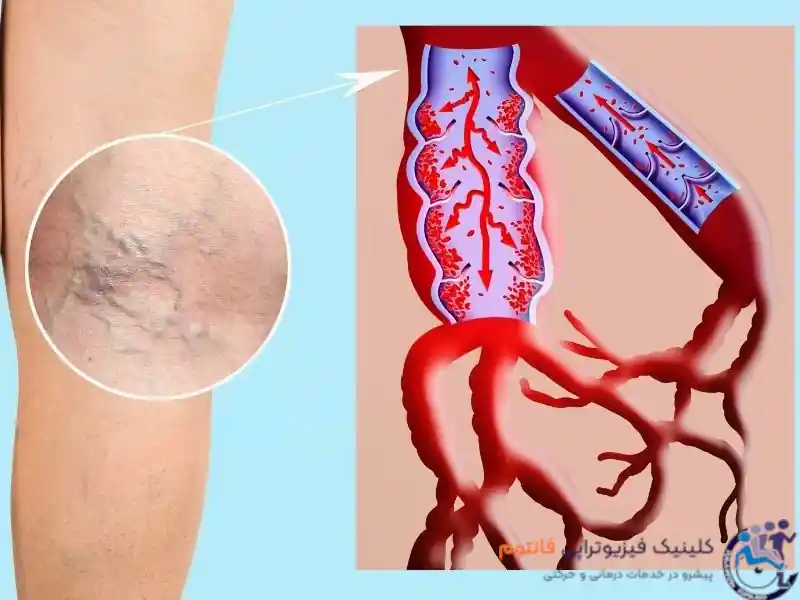 درمان واریس با فیزیوتراپی