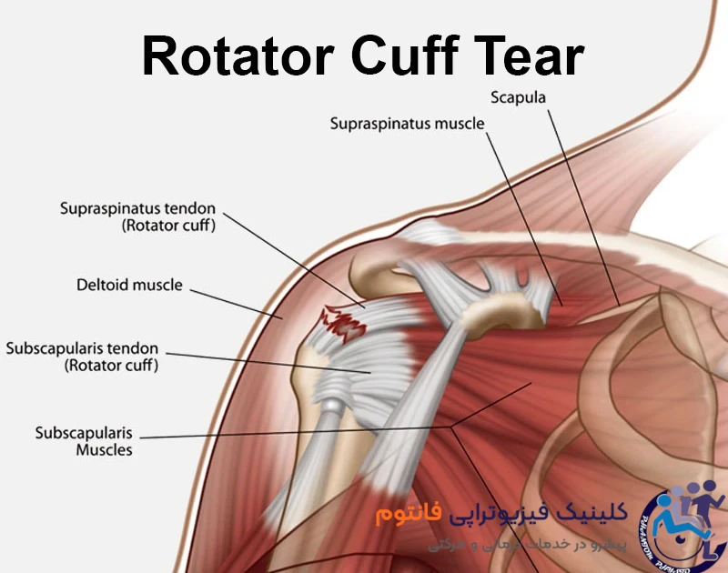 پارگی تاندون شانه